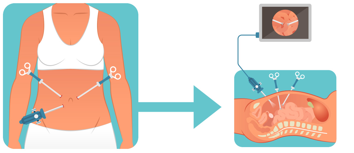 O uso da laparoscopia para a realização das cirurgias de retirada dos focos  visíveis da endometriose tem se mostrado superior à técnica abdominal, By Dr. Yulo Césare