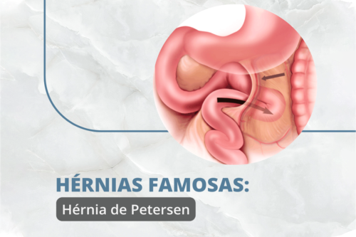 hérnia de petersen
